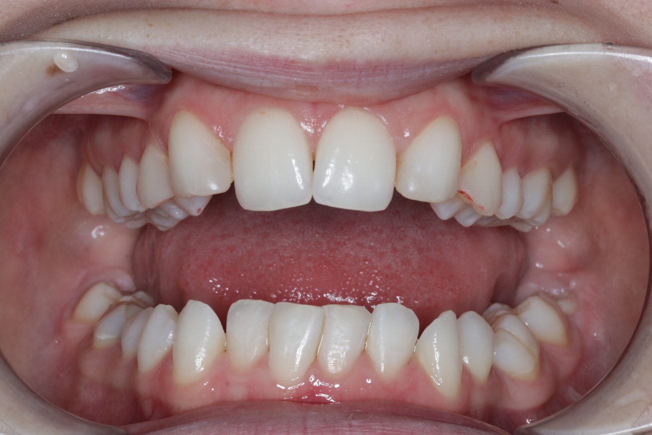 Bottom teeth composite after-1