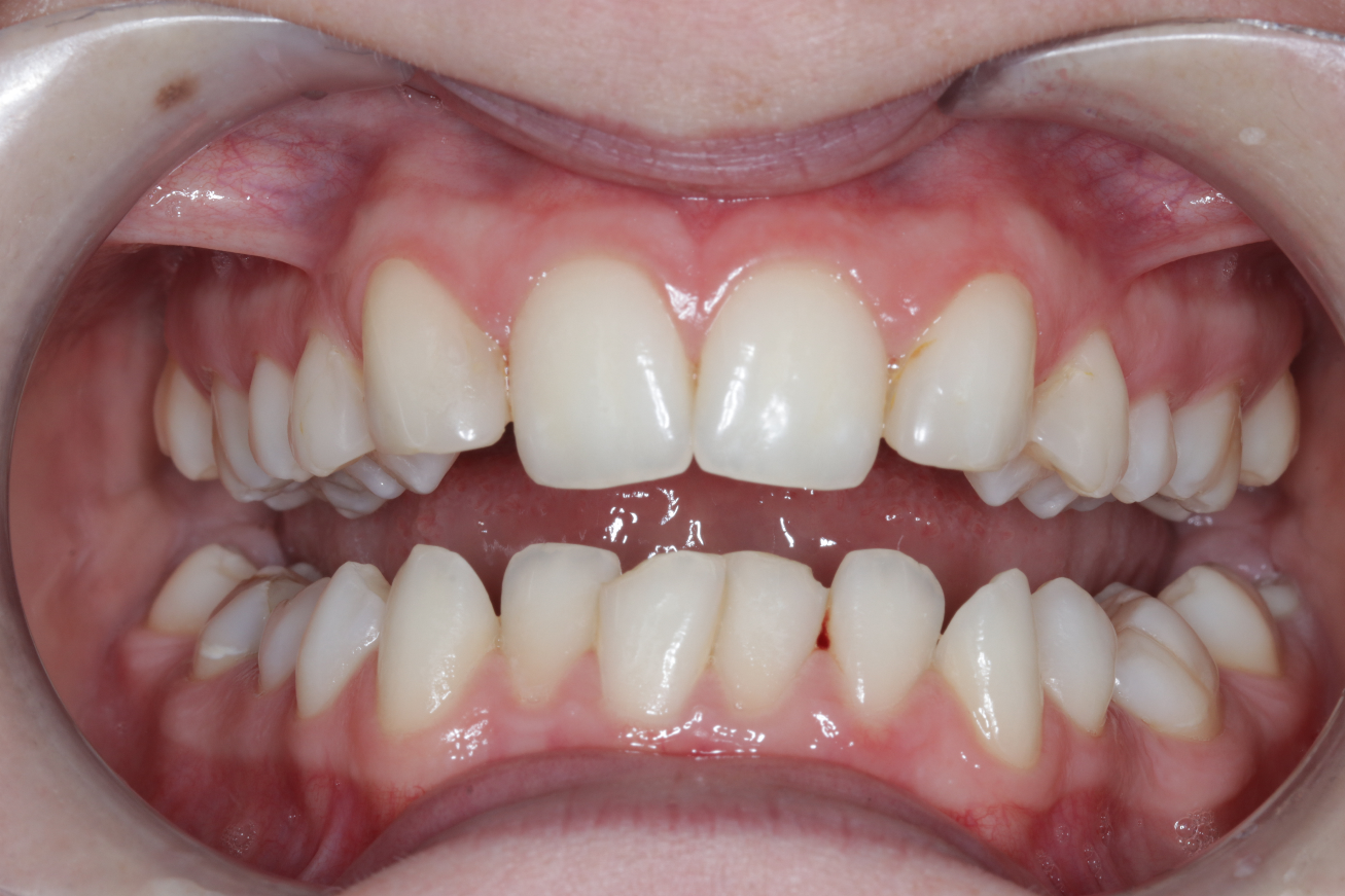 Bottom teeth composite before-1
