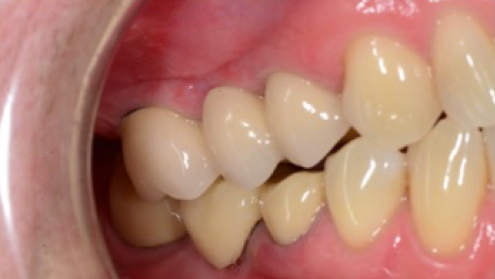 Dental-Implants-and-Bridge-After