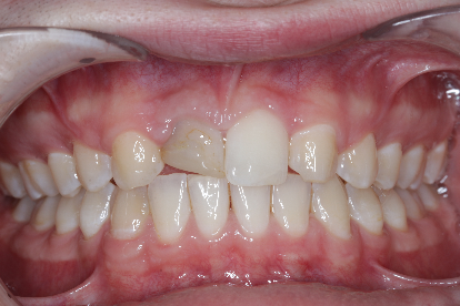 Front tooth composite before