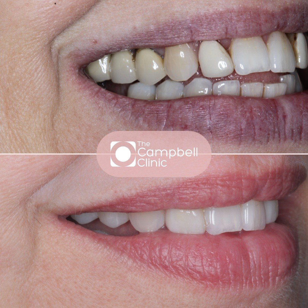 Implant before after
