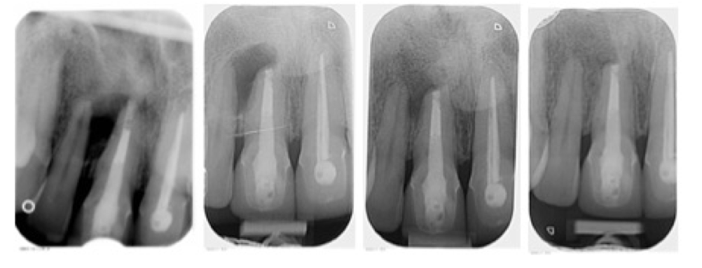 Root-Canal-Treatement