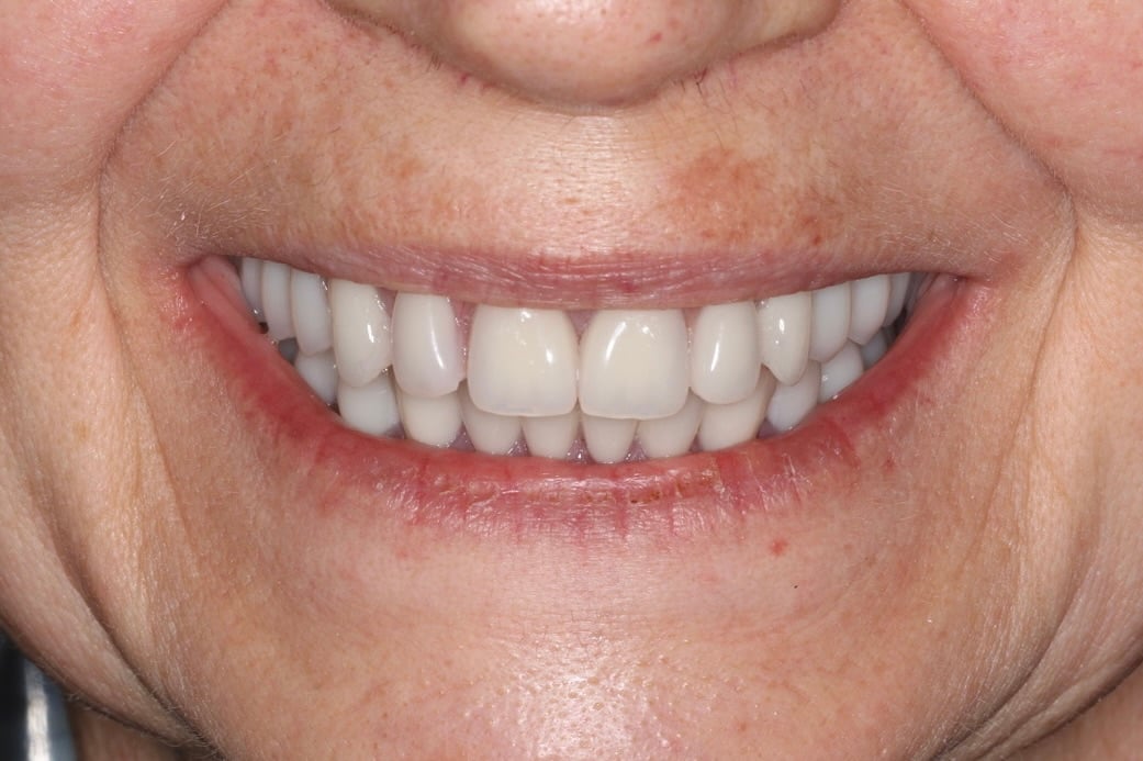 after full arch treatment