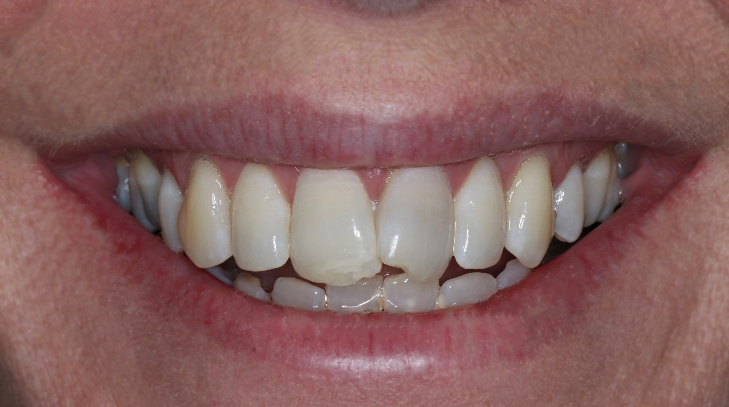 Composite bonding Nottingham 